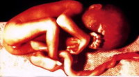 foto aborto omicidio